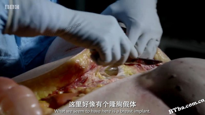 肥胖症:尸检/Obesity The Post Mortem 肥胖症:尸检/Obesity The Post Mortem